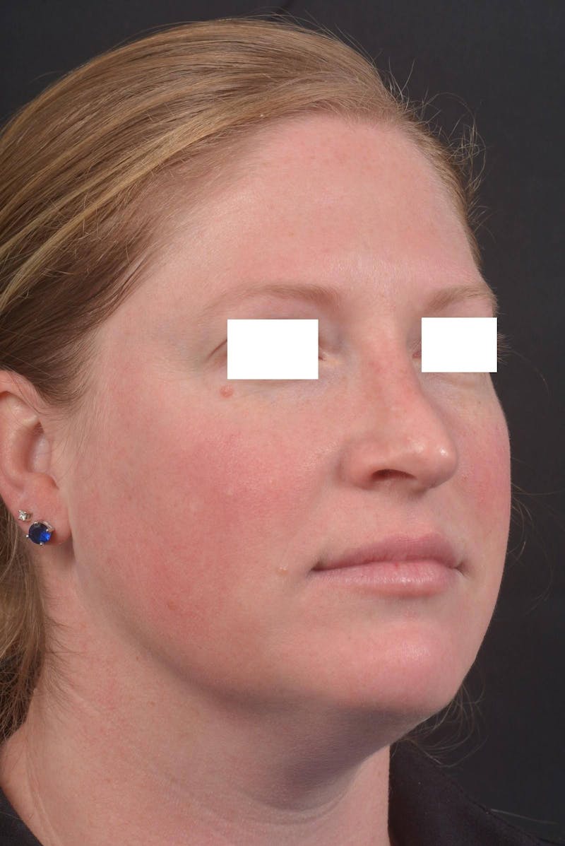 Rhinoplasty Before & After Gallery - Patient 355346 - Image 10