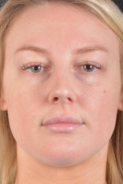 Rhinoplasty Before & After Gallery - Patient 150086 - Image 1