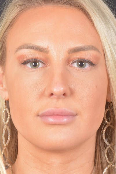 Rhinoplasty Before & After Gallery - Patient 150086 - Image 2
