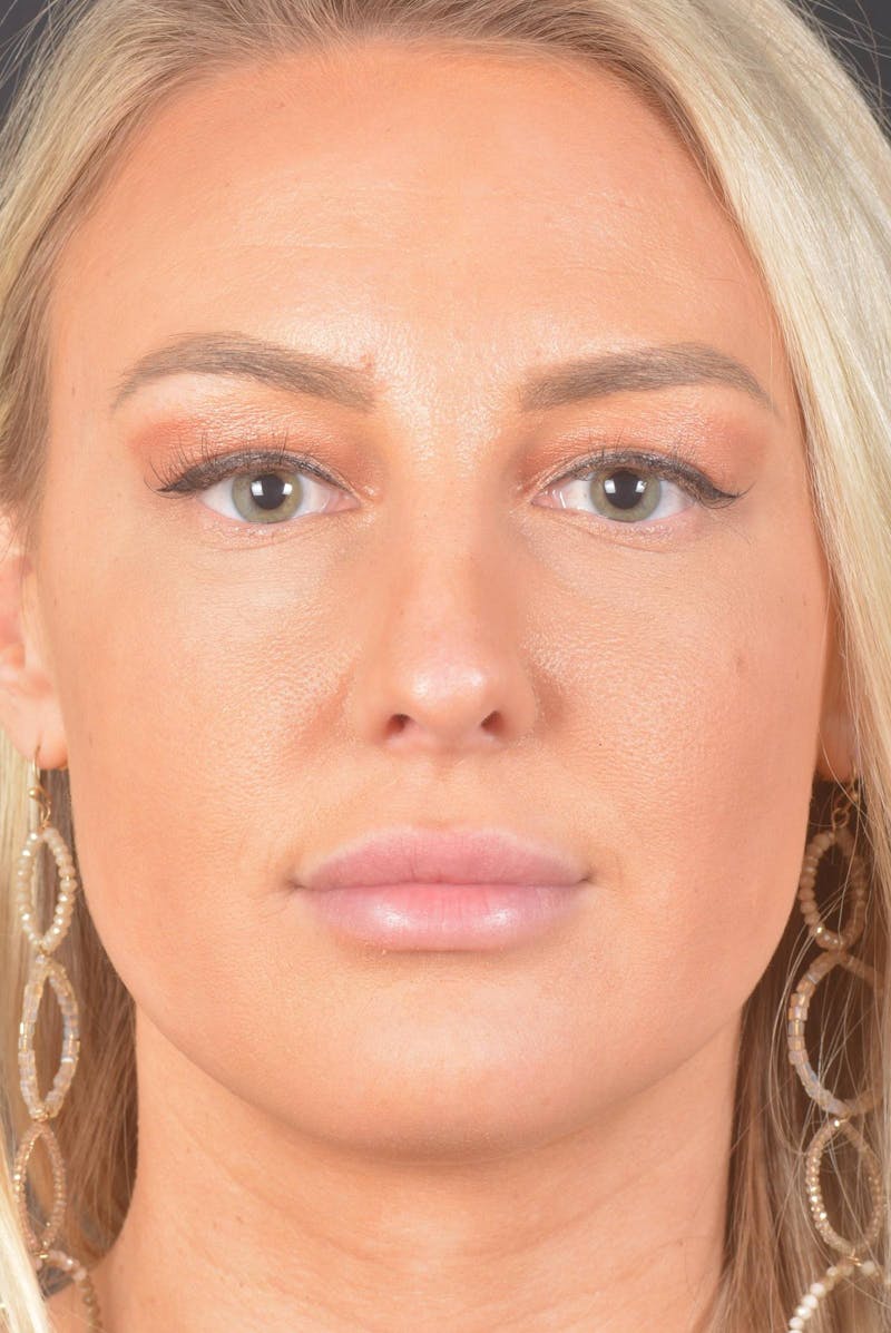 Rhinoplasty Before & After Gallery - Patient 150086 - Image 2