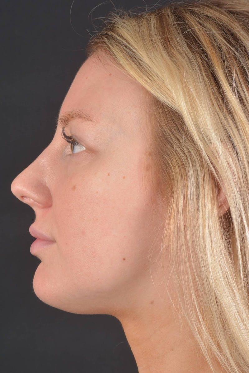 Rhinoplasty Before & After Gallery - Patient 150086 - Image 3
