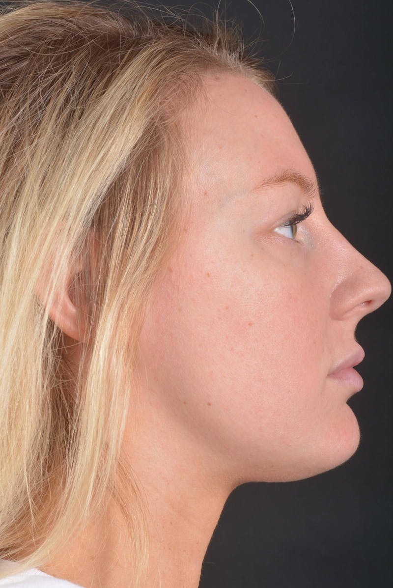 Rhinoplasty Before & After Gallery - Patient 150086 - Image 5