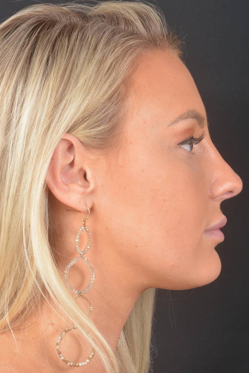 Rhinoplasty Before & After Gallery - Patient 150086 - Image 6