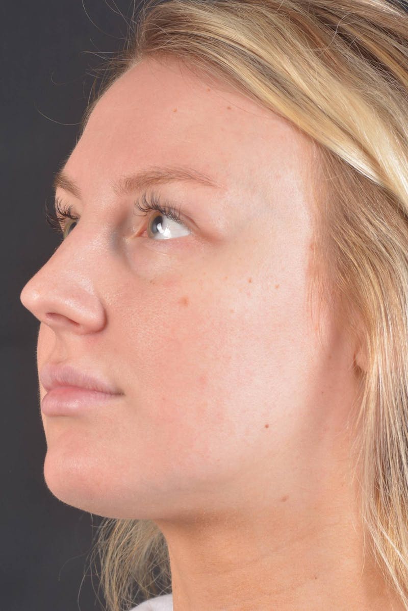 Rhinoplasty Before & After Gallery - Patient 150086 - Image 7