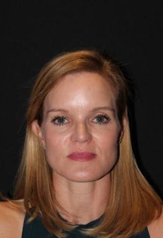 Rhinoplasty Before & After Gallery - Patient 129649 - Image 2