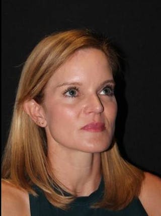 Rhinoplasty Before & After Gallery - Patient 129649 - Image 8