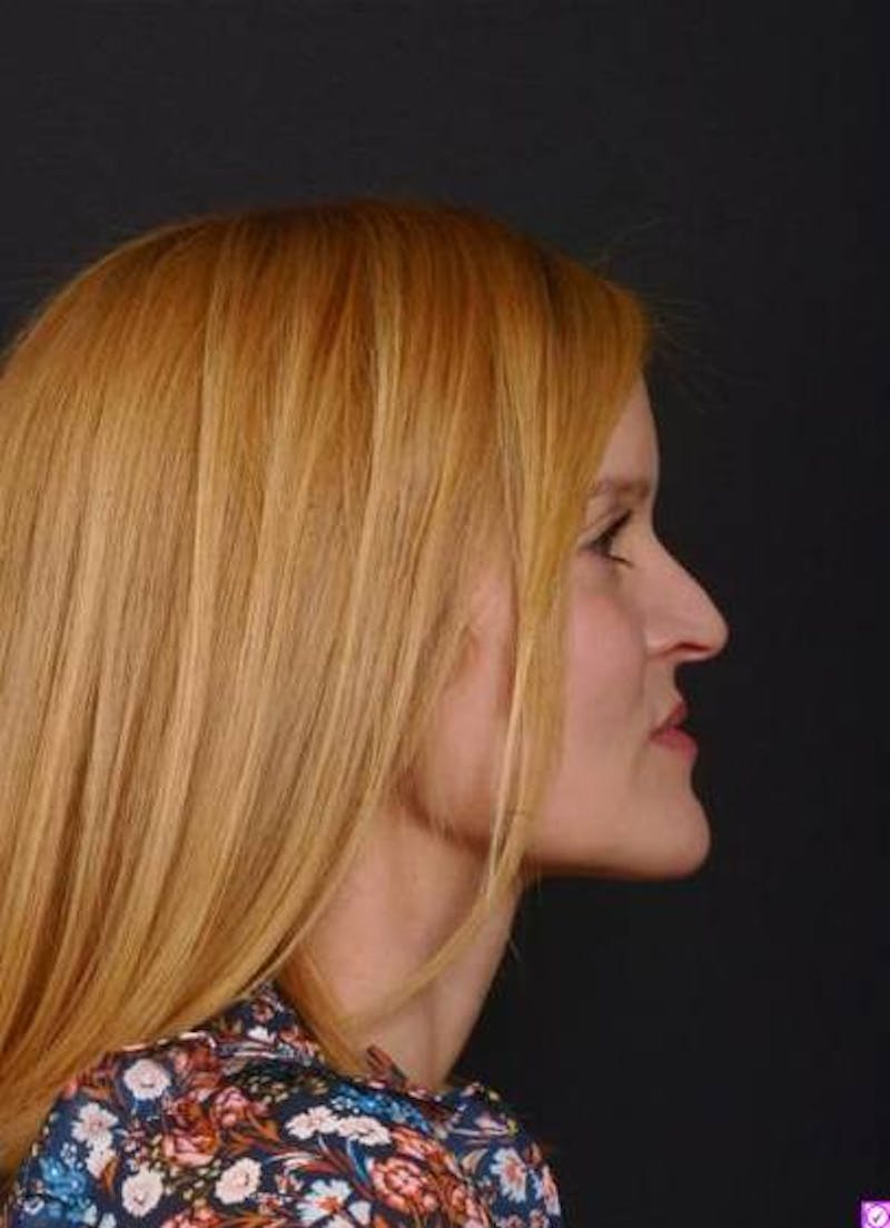 Rhinoplasty Before & After Gallery - Patient 129649 - Image 9