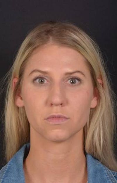 Rhinoplasty Before & After Gallery - Patient 395551 - Image 1