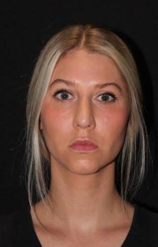 Rhinoplasty Before & After Gallery - Patient 395551 - Image 2