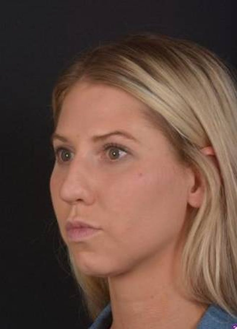 Rhinoplasty Before & After Gallery - Patient 395551 - Image 3
