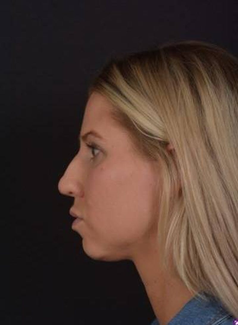 Rhinoplasty Before & After Gallery - Patient 395551 - Image 5