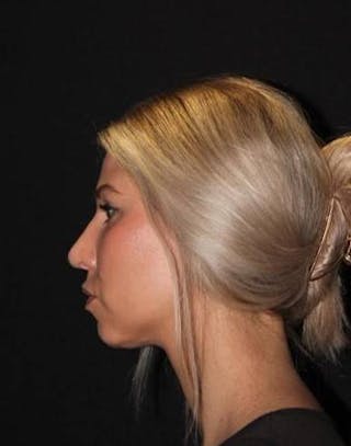 Rhinoplasty Before & After Gallery - Patient 395551 - Image 6