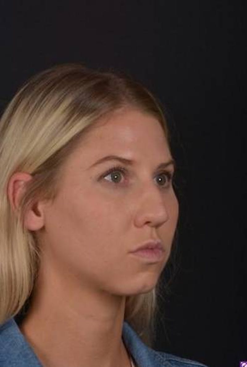 Rhinoplasty Before & After Gallery - Patient 395551 - Image 7