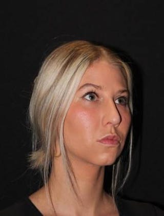 Rhinoplasty Before & After Gallery - Patient 395551 - Image 8