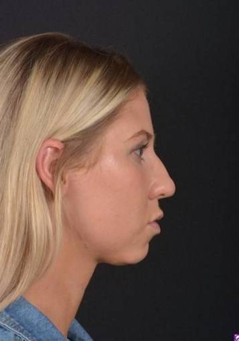 Rhinoplasty Before & After Gallery - Patient 395551 - Image 9