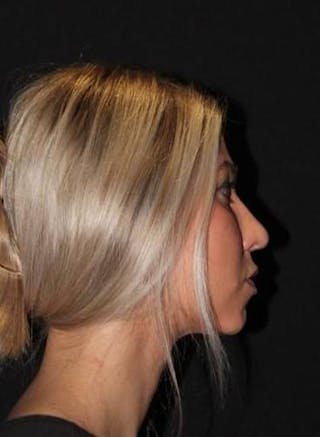 Rhinoplasty Before & After Gallery - Patient 395551 - Image 10