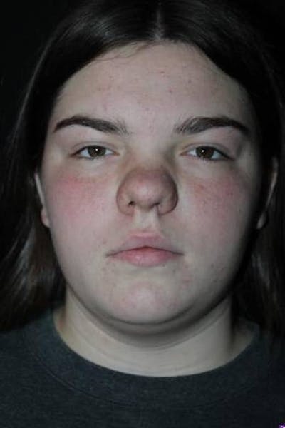 Rhinoplasty Before & After Gallery - Patient 136196 - Image 1