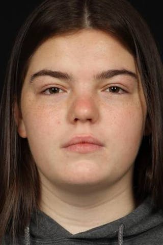 Rhinoplasty Before & After Gallery - Patient 136196 - Image 2