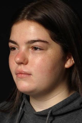 Rhinoplasty Before & After Gallery - Patient 136196 - Image 4