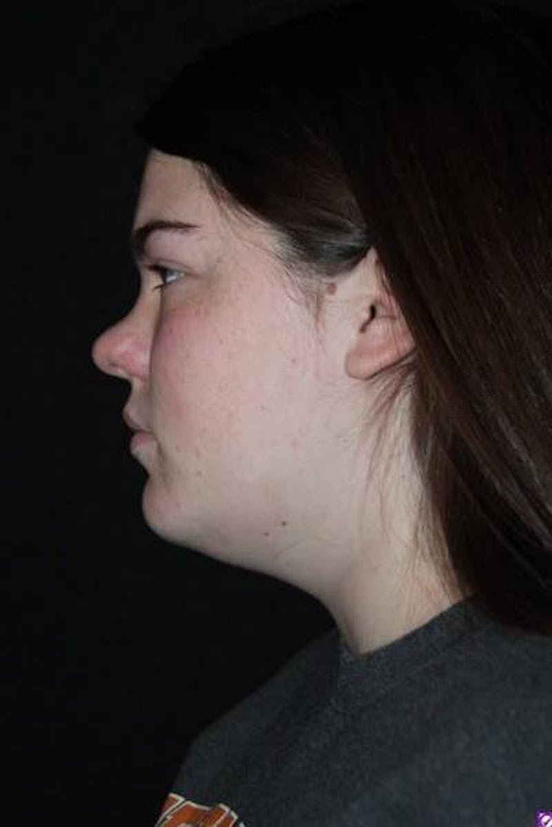 Rhinoplasty Before & After Gallery - Patient 136196 - Image 5