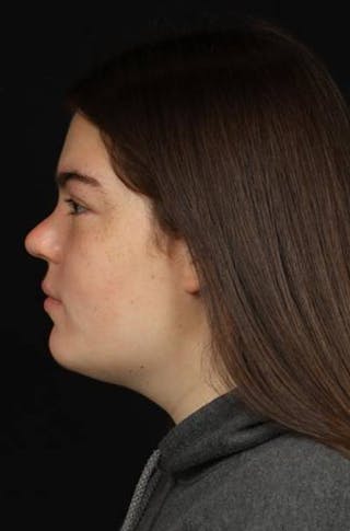 Rhinoplasty Before & After Gallery - Patient 136196 - Image 6