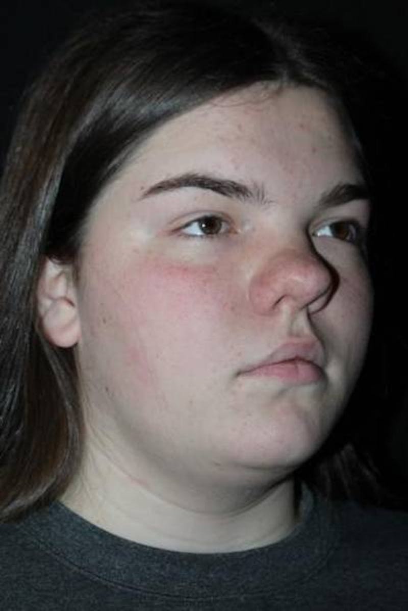 Rhinoplasty Before & After Gallery - Patient 136196 - Image 7
