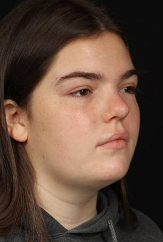 Rhinoplasty Before & After Gallery - Patient 136196 - Image 8