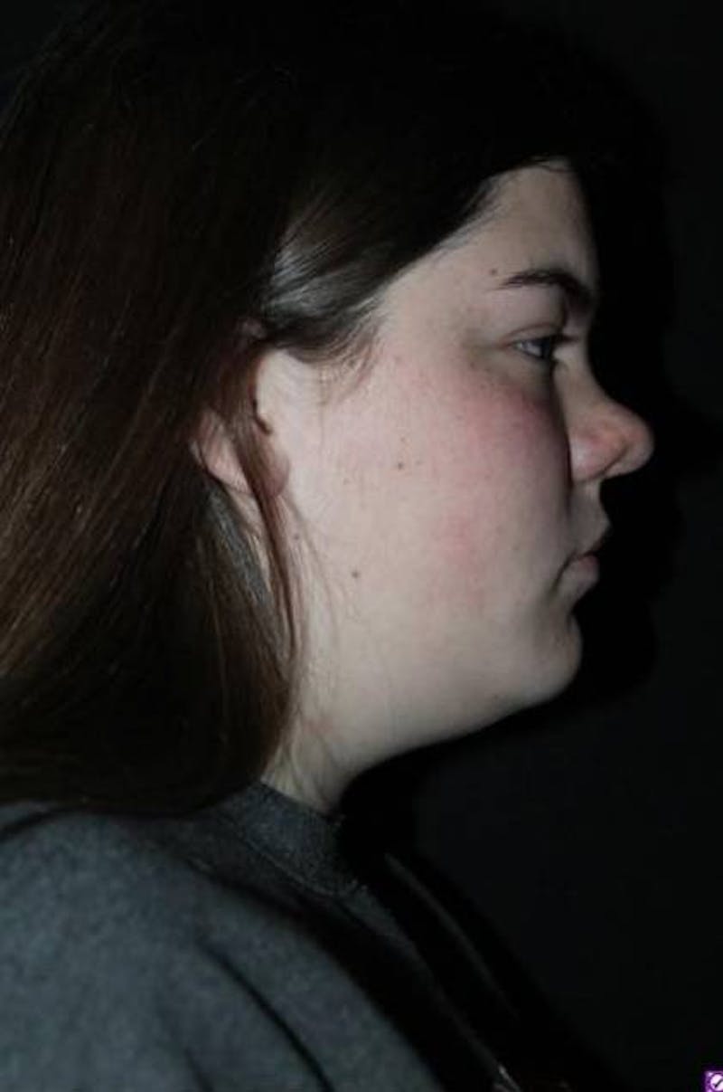 Rhinoplasty Before & After Gallery - Patient 136196 - Image 9