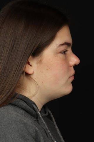 Rhinoplasty Before & After Gallery - Patient 136196 - Image 10