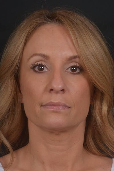 Rhinoplasty Before & After Gallery - Patient 325130 - Image 1
