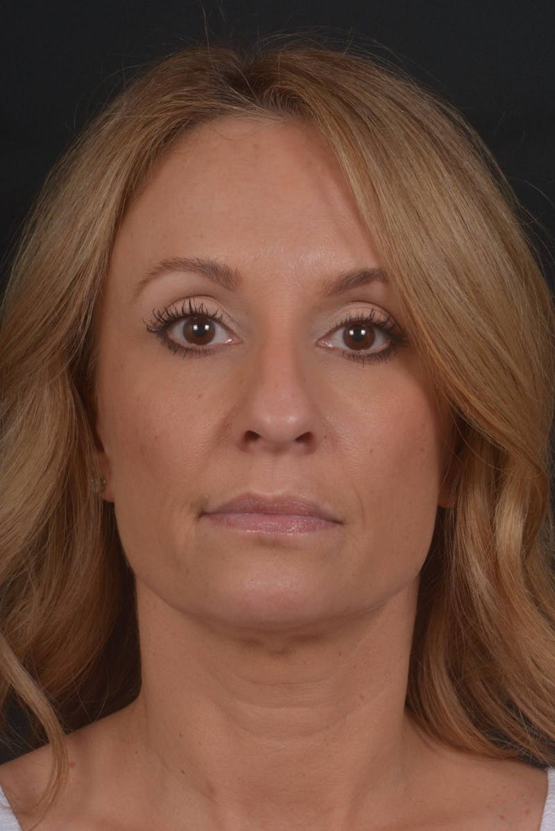 Rhinoplasty Before & After Gallery - Patient 325130 - Image 1
