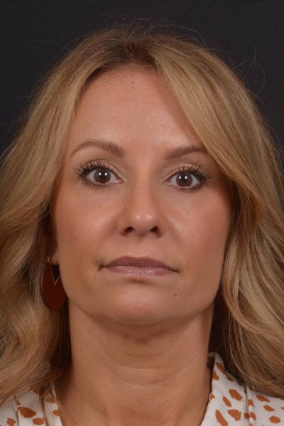 Rhinoplasty Before & After Gallery - Patient 325130 - Image 2