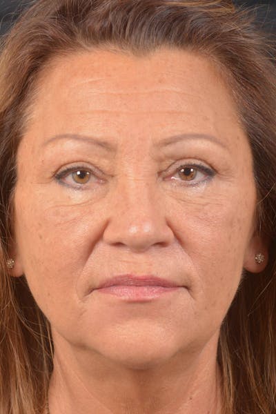 Blepharoplasty Before & After Gallery - Patient 371286 - Image 1