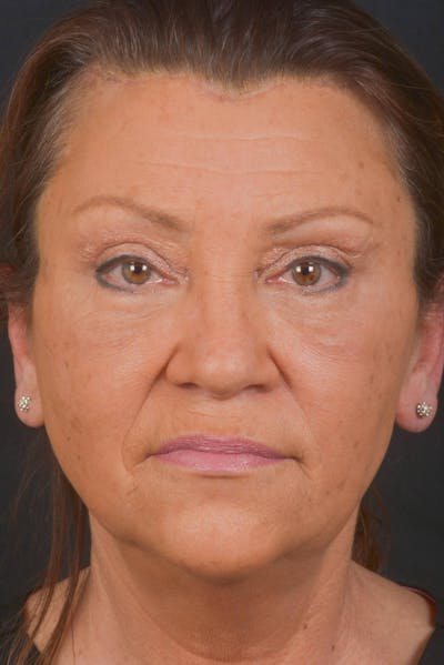 Blepharoplasty Before & After Gallery - Patient 371286 - Image 2