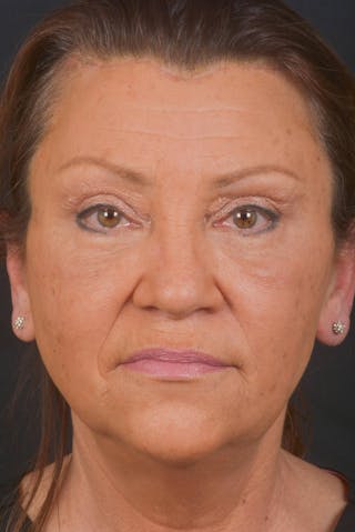 Blepharoplasty Before & After Gallery - Patient 371286 - Image 2