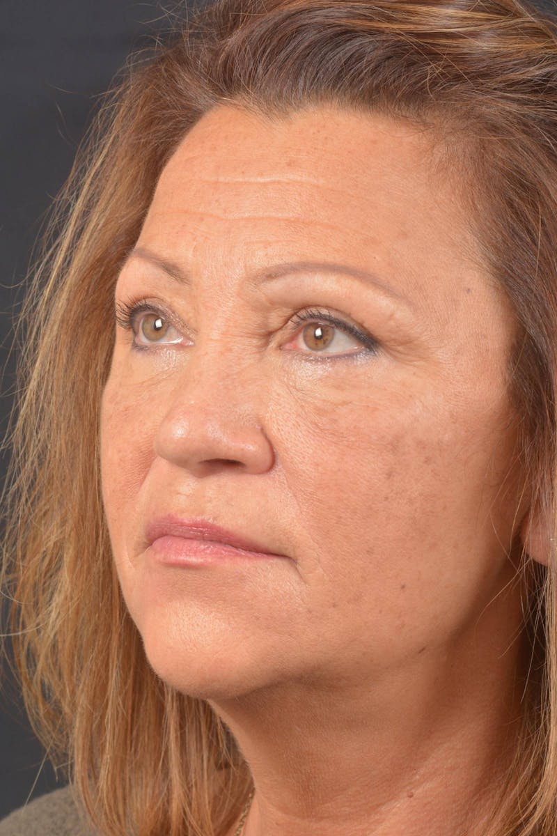 Blepharoplasty Before & After Gallery - Patient 371286 - Image 3