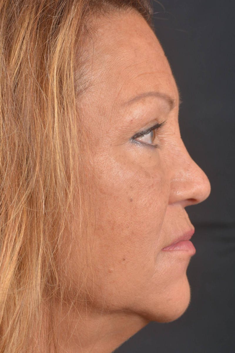 Blepharoplasty Before & After Gallery - Patient 371286 - Image 5