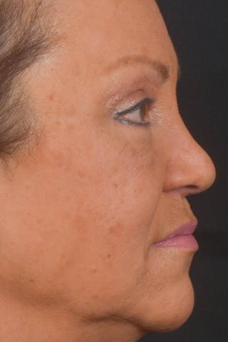 Blepharoplasty Before & After Gallery - Patient 371286 - Image 6