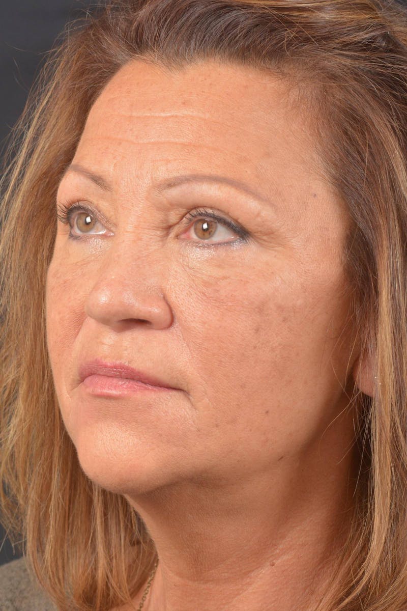 Blepharoplasty Before & After Gallery - Patient 371286 - Image 7