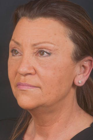 Blepharoplasty Before & After Gallery - Patient 371286 - Image 8