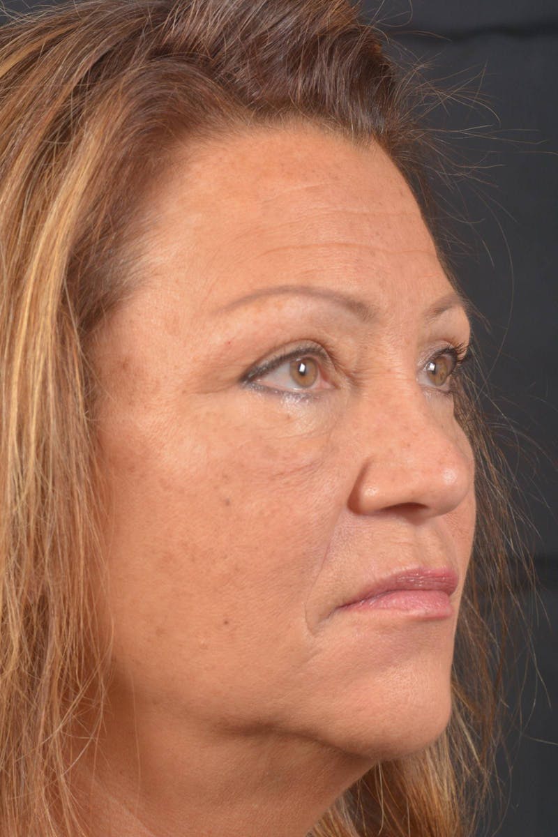 Blepharoplasty Before & After Gallery - Patient 371286 - Image 9