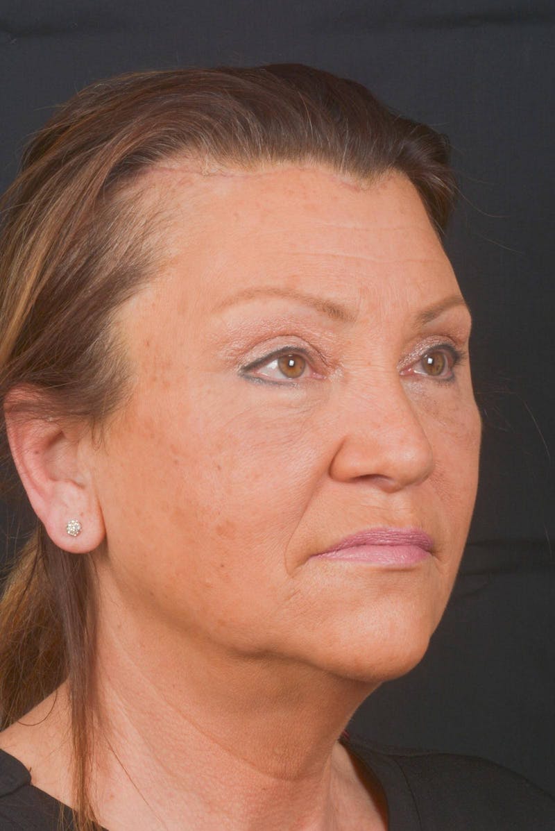 Blepharoplasty Before & After Gallery - Patient 371286 - Image 10