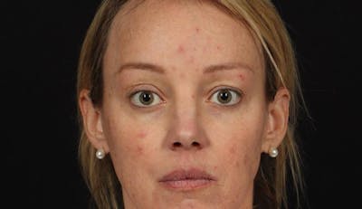 Blepharoplasty Before & After Gallery - Patient 160231 - Image 1