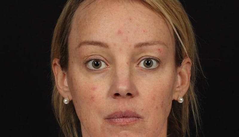Blepharoplasty Before & After Gallery - Patient 160231 - Image 1