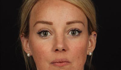Blepharoplasty Before & After Gallery - Patient 160231 - Image 2