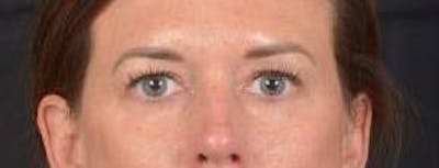 Blepharoplasty Before & After Gallery - Patient 120191 - Image 1