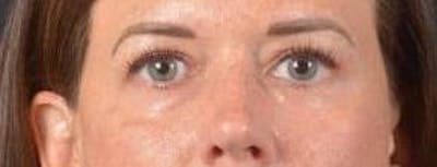 Blepharoplasty Before & After Gallery - Patient 120191 - Image 2