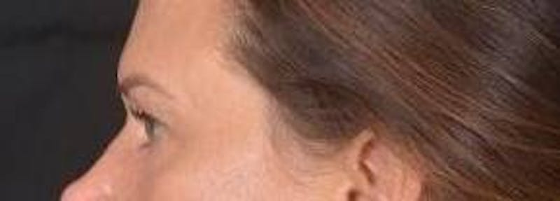 Blepharoplasty Before & After Gallery - Patient 120191 - Image 3