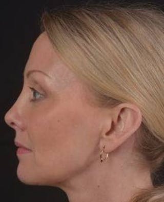Blepharoplasty Before & After Gallery - Patient 214717 - Image 4