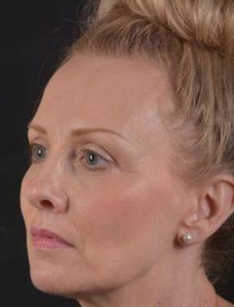 Blepharoplasty Before & After Gallery - Patient 214717 - Image 5
